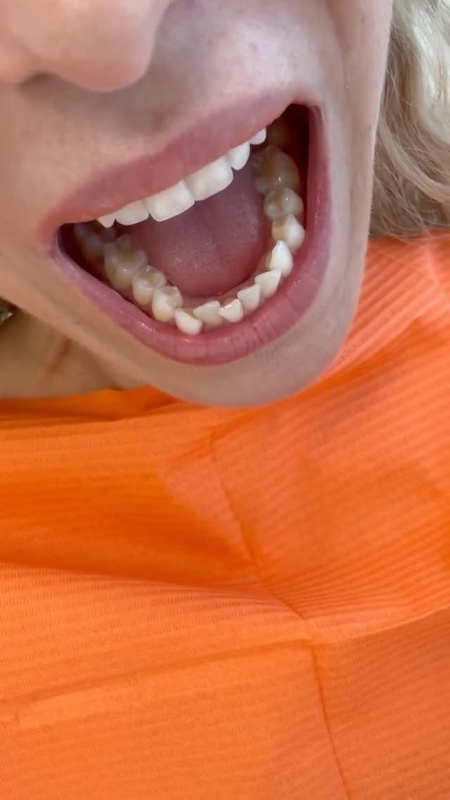 Anzeige🦷 Schaut mal wie sich meine Zähne entwickeln!😍 Unglaublich, wie schräg vorallem mein Unterkiefer Anfangs war!!Für alle die es interessiert: Ich lasse eine fast unsichtbare Zahnkorrektur mit Angel Aligners bei @med.and.dent in Luzern mit ihrem Kieferorthopäden machen 🧡Bald sind wir fertig und ich werde endlich das Endergebnis sehen 🤩 aber ich bin jetzt schon super glücklich!!!! by @anjazeidler