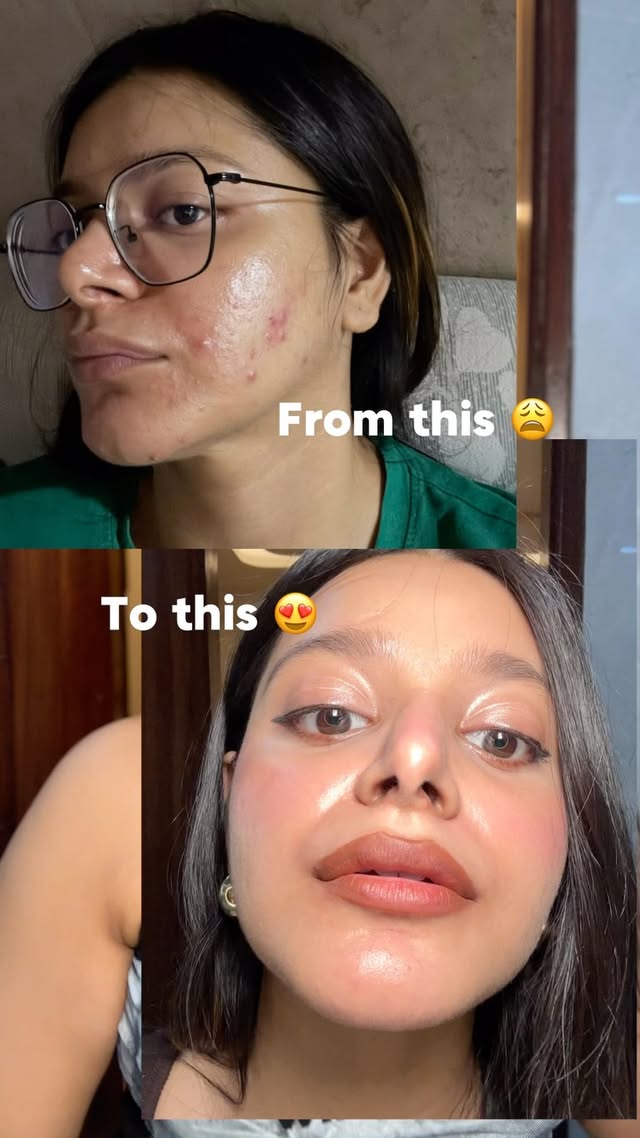 Comment for product link ✨🔗.Follow me for more related reels, we can fix this together 💪💓.....Acne, acne prone skin, acne skincare routine, acne cleanser, gentle facewash, acne safe products, acne safe cleanser, skincare routine, skincare by @kajal_goyal__